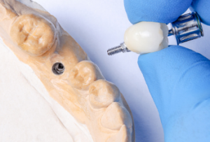 YesDentistry dental implants Adelaide